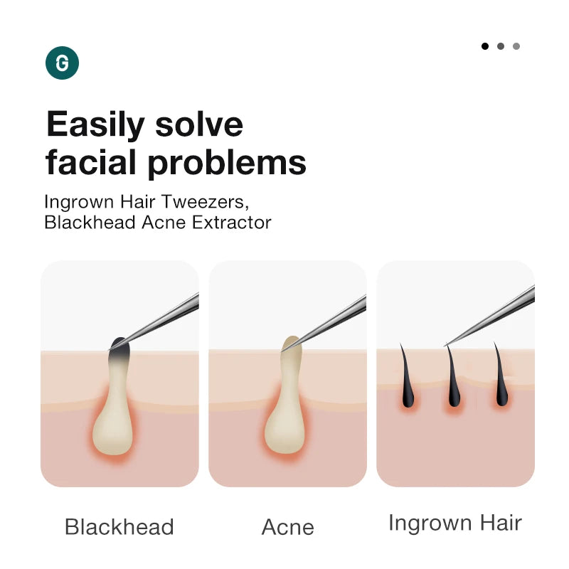 Ingrown Hair Tweezers Needle Nose Pointed Tips Eyebrows Tweezers
