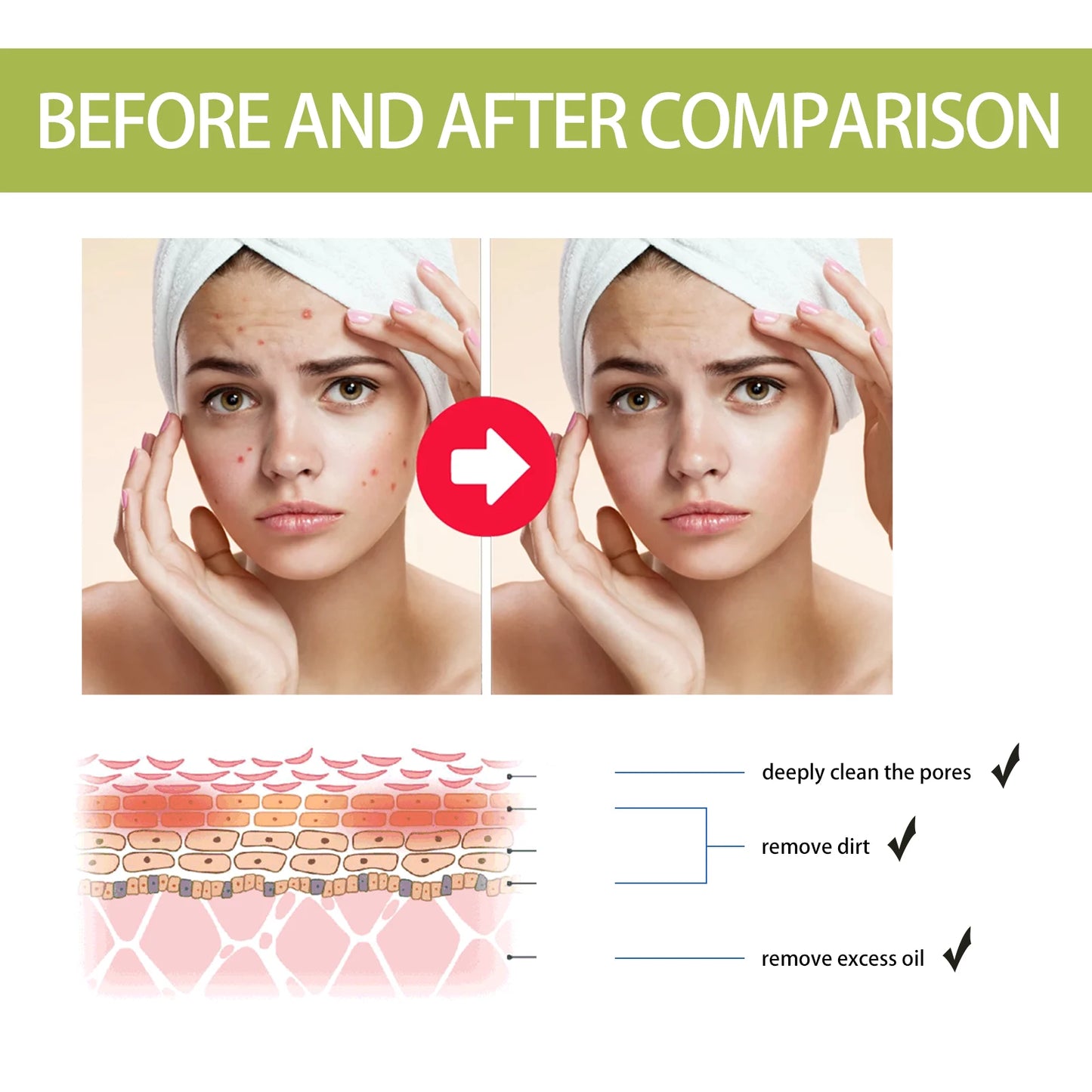 Tea Tree Oil Essence for Acne Scar Reduction Moisturizing and Pore-tightening