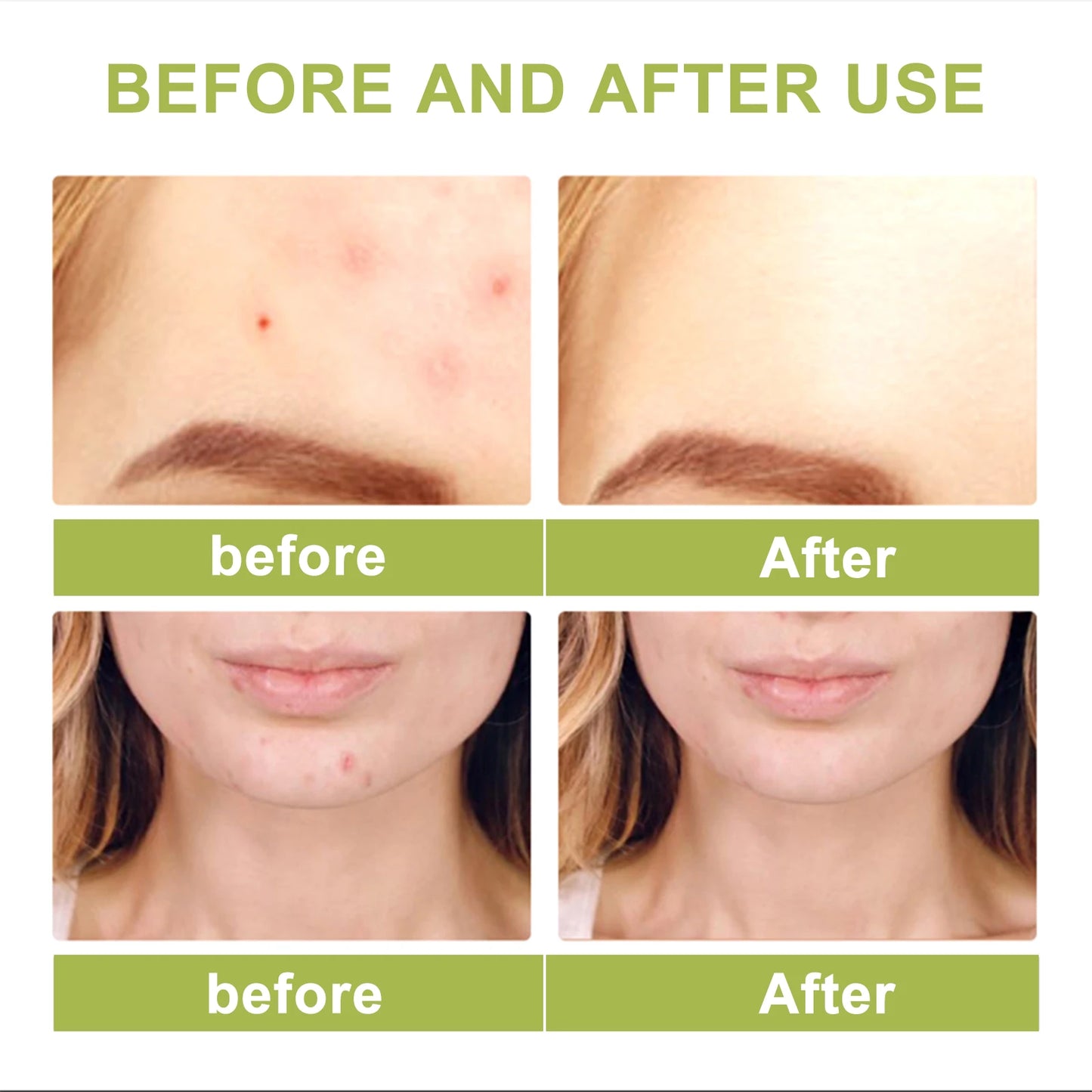 Tea Tree Oil Essence for Acne Scar Reduction Moisturizing and Pore-tightening