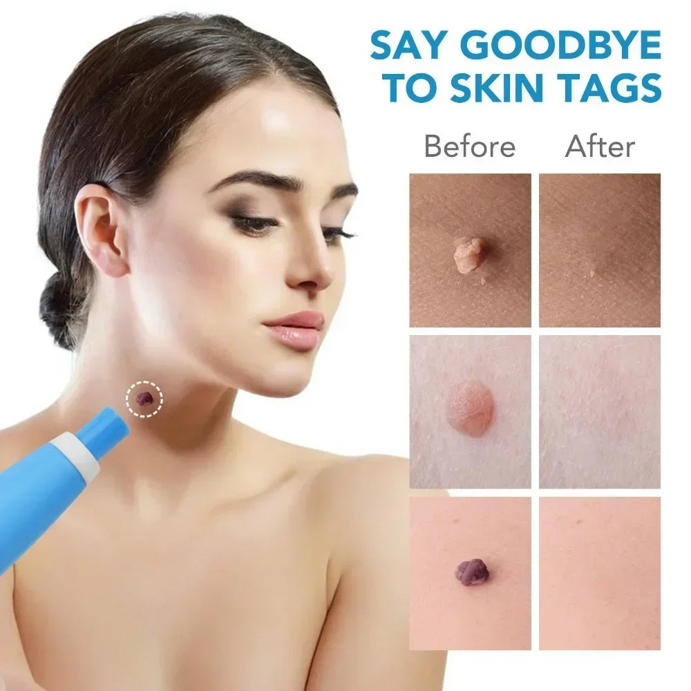2 In1 Painless Auto Skin Tag Mole Wart Removal Kit  Face Skin Care